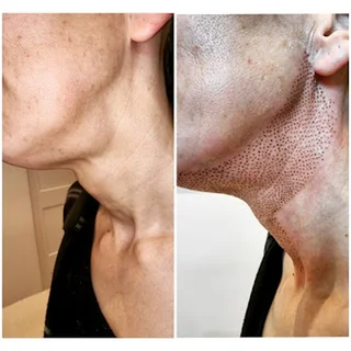 Photo Aesthetics & Plasma Pen skin tightening