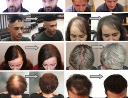 Hair Loss Treatment London - Mane UK