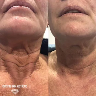 Photo Aesthetics & Plasma Pen skin tightening