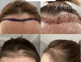 Harley Street Hair Transplant Clinic