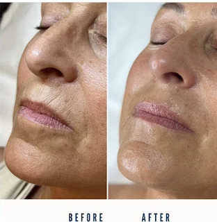 Photo Faydra Skin | Facial Sculpting