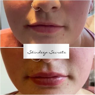 Photo Lip Fillers Gloucester - Skindeep Secrets