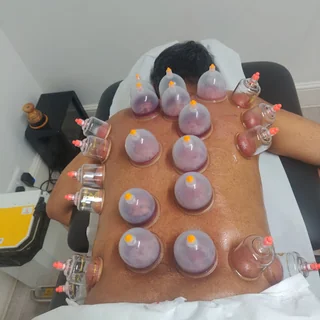 Photo Cupping Hijama in London, E12, London