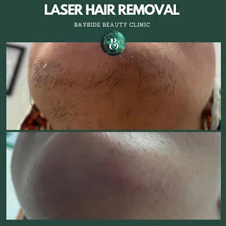 Photo Laser Hair Removal Walsall | Bayside Aesthetics