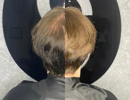 Solution Hair Replacement