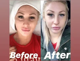 Botox Stoke | Lip Fillers Stoke | - Bayside Beauty Clinic