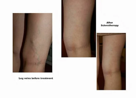 Photo Coltishall Clinic Laser Skin and Vein Care