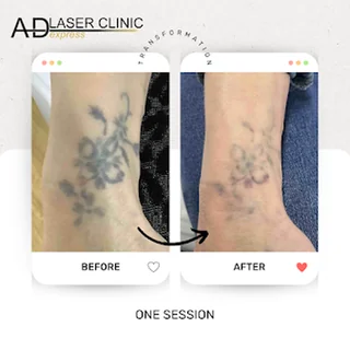 Photo AD LASER CLINIC EXPRESS PUTNEY