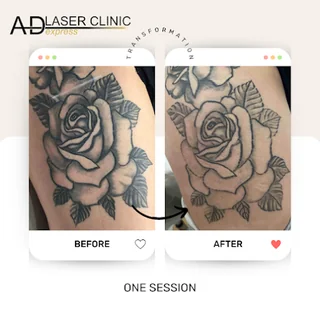 Photo AD LASER CLINIC EXPRESS PUTNEY