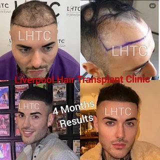 Photo Liverpool Hair Transplant Clinic