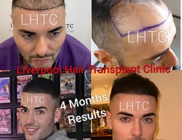 Liverpool Hair Transplant Clinic