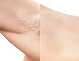 LMS Clinic - Laser Hair Removal