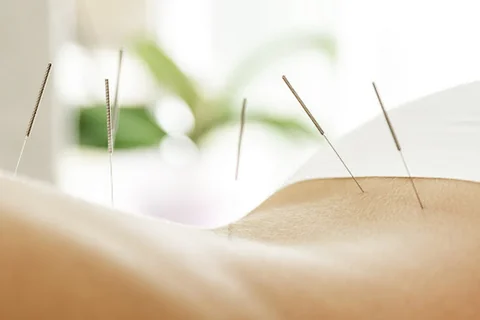 Photo YOLO Acupuncture