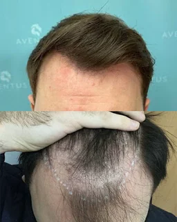 Photo Aventus Clinic - Hair Transplant and Dermatology Specialists