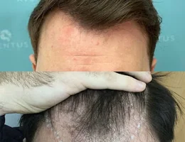 Aventus Clinic - Hair Transplant and Dermatology Specialists