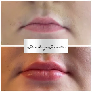 Photo Lip Fillers Gloucester - Skindeep Secrets