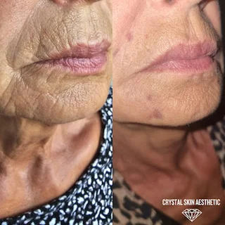 Photo Aesthetics & Plasma Pen skin tightening