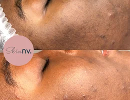 Skin NV Birmingham Facial Specialist