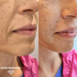 Photo Aesthetics & Plasma Pen skin tightening