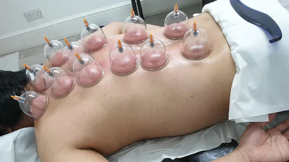 Photo Cupping Hijama in London, E12, London