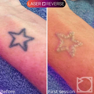 Photo Laser Reverse