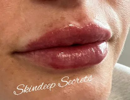 Photo Lip Fillers Gloucester - Skindeep Secrets