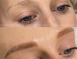 Enhanced Faces Aesthetics - Dermal Fillers & Anti-Wrinkle in Bury St Edmunds