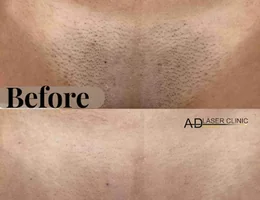 AD LASER CLINIC EXPRESS PUTNEY