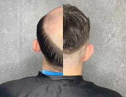 Solution Hair Replacement