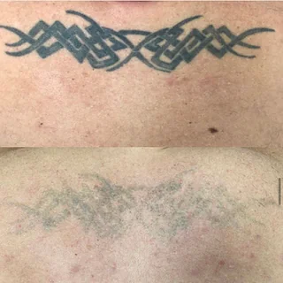 Photo Laser Meg Limited Tattoo Removal & Skin Rejuvenation