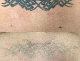 Laser Meg Limited Tattoo Removal & Skin Rejuvenation