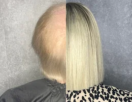 Solution Hair Replacement