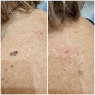 Photo Aesthetics & Plasma Pen skin tightening