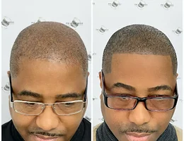 Permanent makeup & Scalp Micropigmentation London