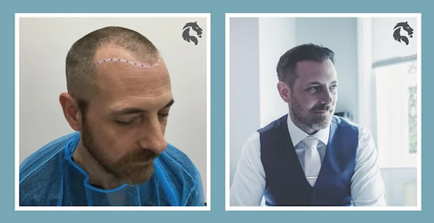 Photo Aventus Clinic - Hair Transplant and Dermatology Specialists