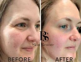 Skin Restore