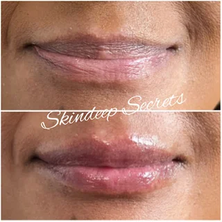 Photo Lip Fillers Gloucester - Skindeep Secrets