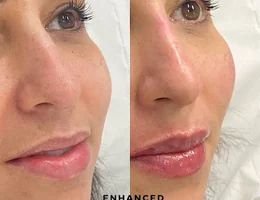 Enhanced Faces Aesthetics - Dermal Fillers & Anti-Wrinkle in Bury St Edmunds