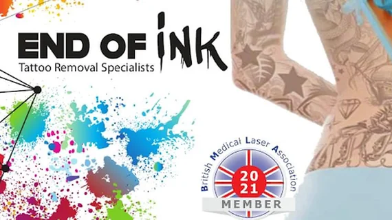 Photo End Of Ink Laser Tattoo Removal