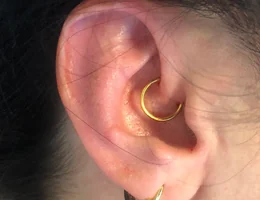 Daith Piercing for Migraine Harley Street London