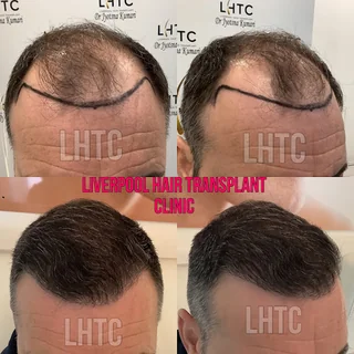 Photo Liverpool Hair Transplant Clinic