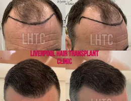 Liverpool Hair Transplant Clinic