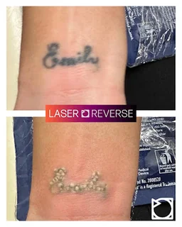 Photo Laser Reverse