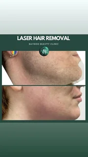 Photo Laser Hair Removal Walsall | Bayside Aesthetics