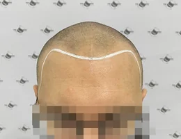 Permanent makeup & Scalp Micropigmentation London